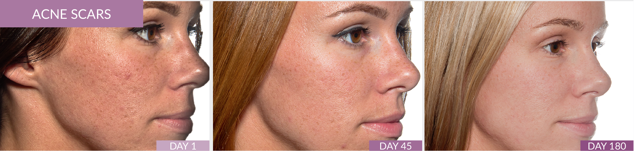 Fusion scar gel: acne scars.
